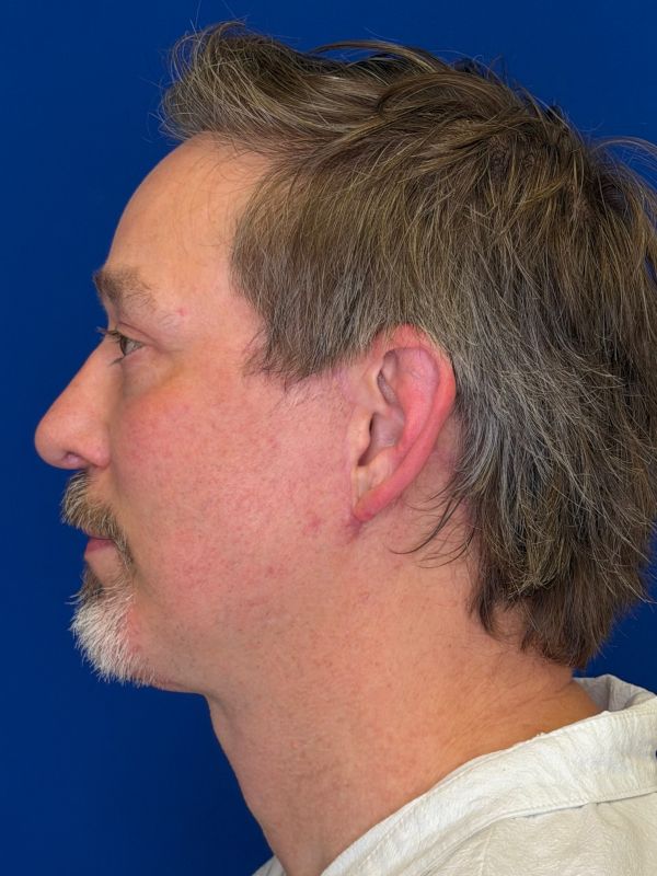 Facelift Before & After Image