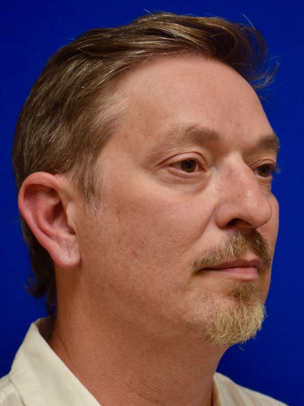 Facelift Before & After Image