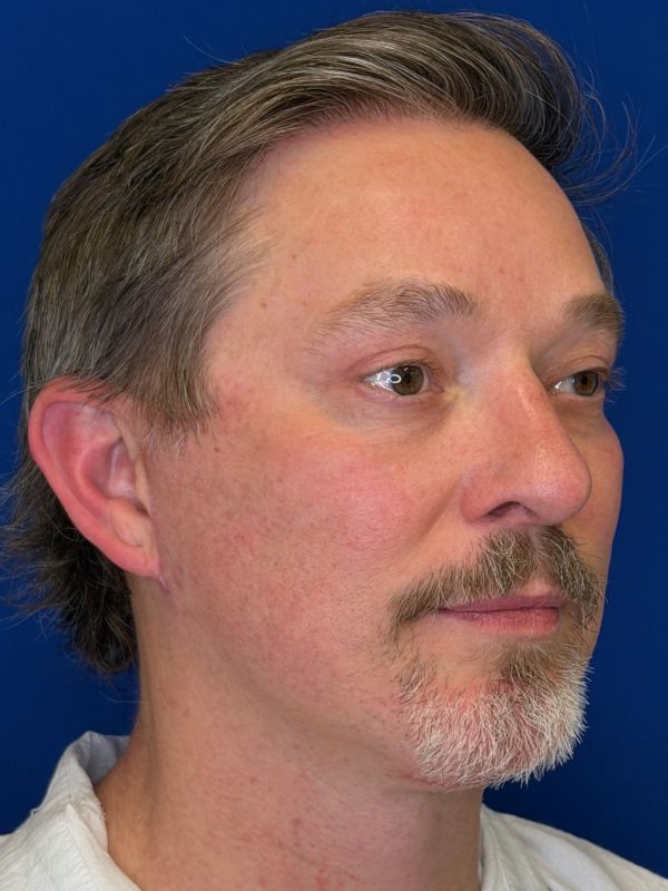 Facelift Before & After Image
