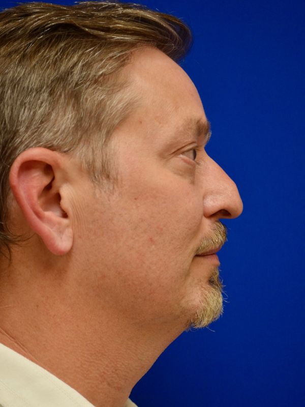 Facelift Before & After Image