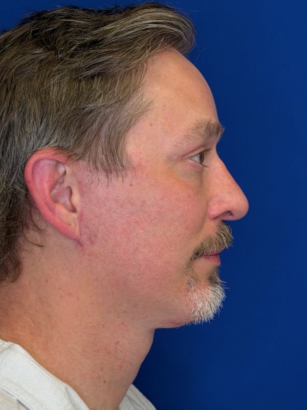 Facelift Before & After Image