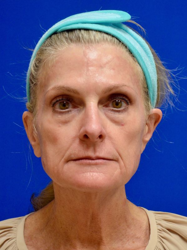 Facelift Before & After Image