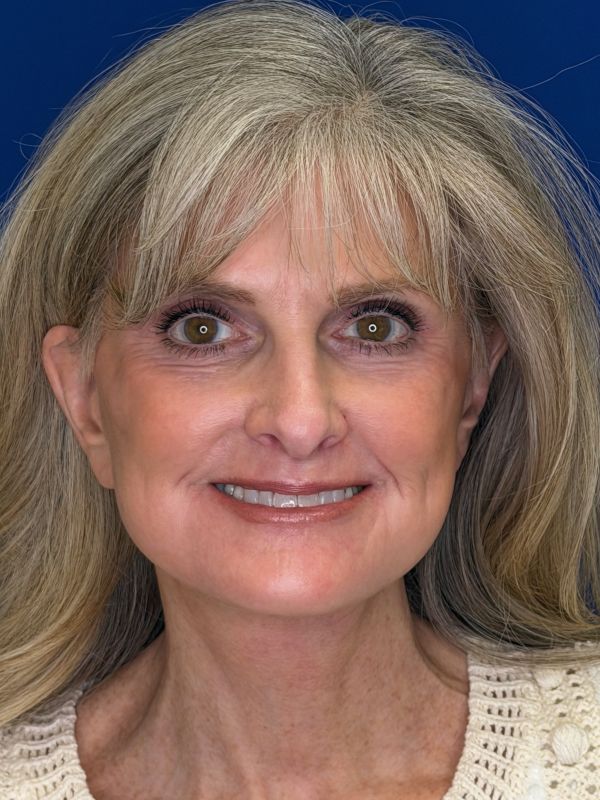Facelift Before & After Image
