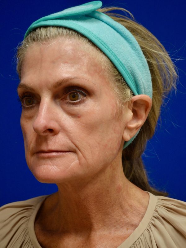 Facelift Before & After Image
