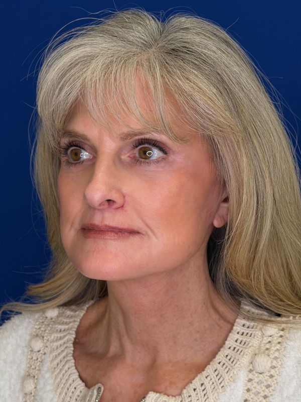 Facelift Before & After Image