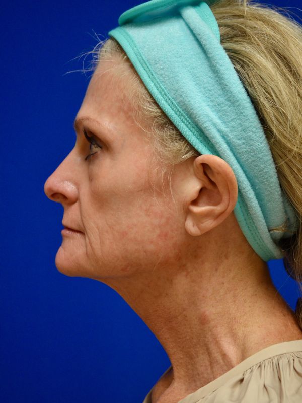 Facelift Before & After Image