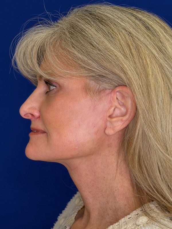 Facelift Before & After Image