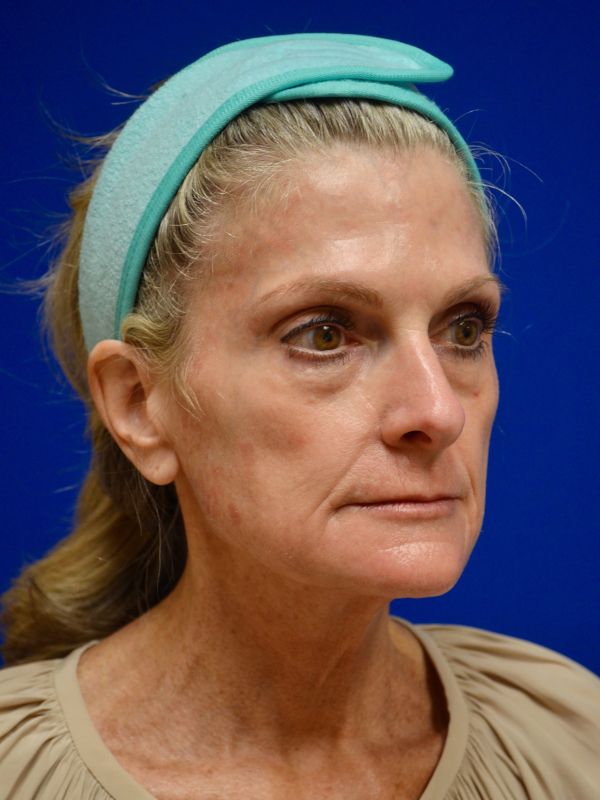 Facelift Before & After Image