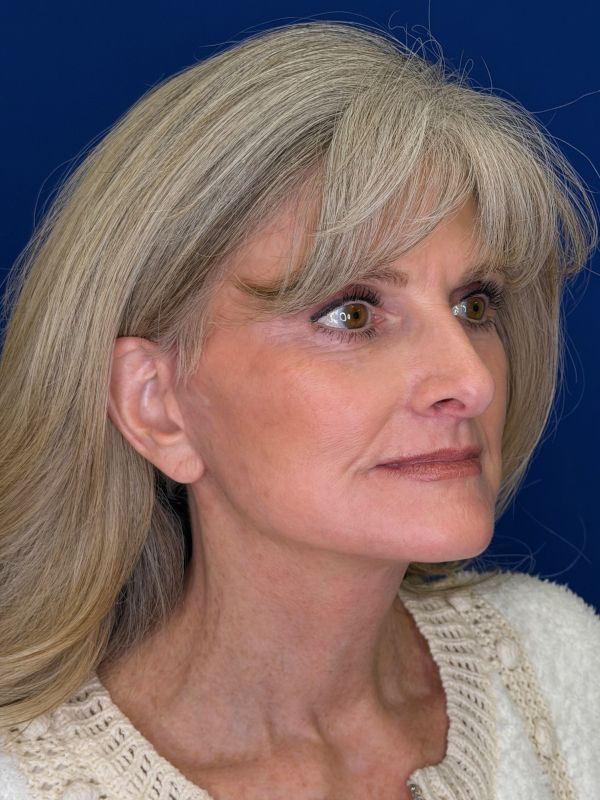 Facelift Before & After Image