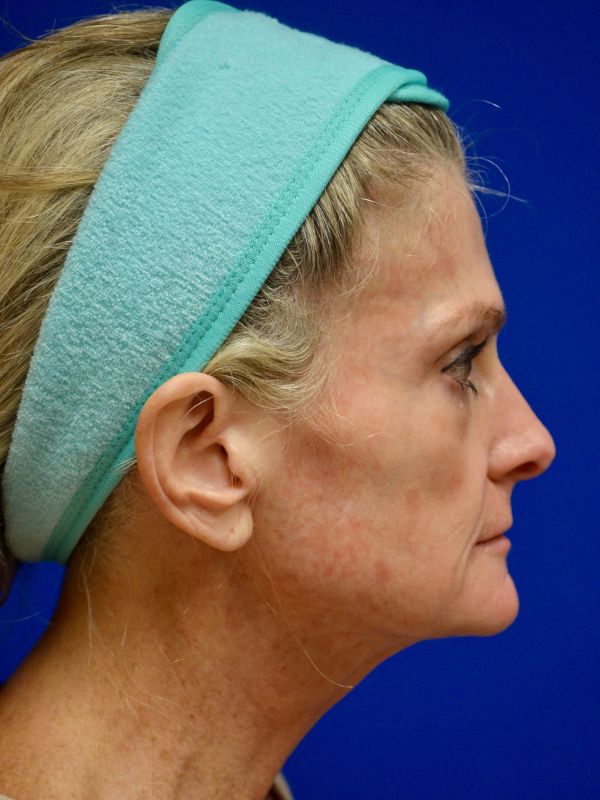 Facelift Before & After Image