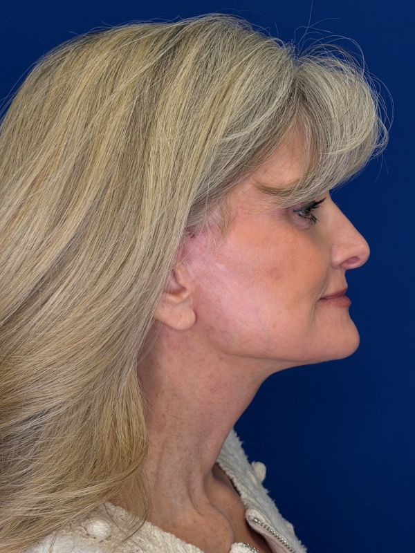 Facelift Before & After Image