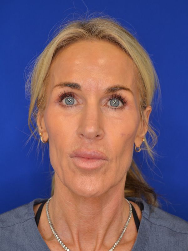 Facelift Before & After Image