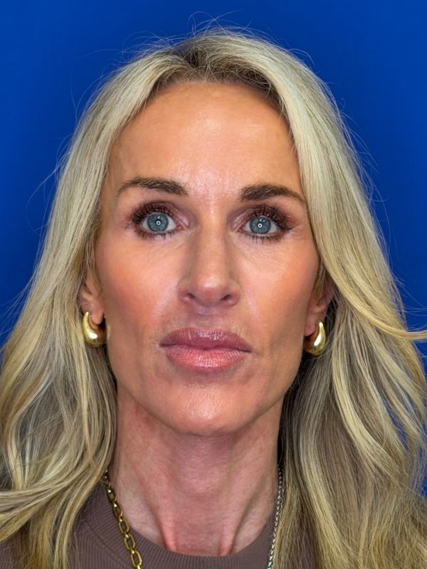 Facelift Before & After Image