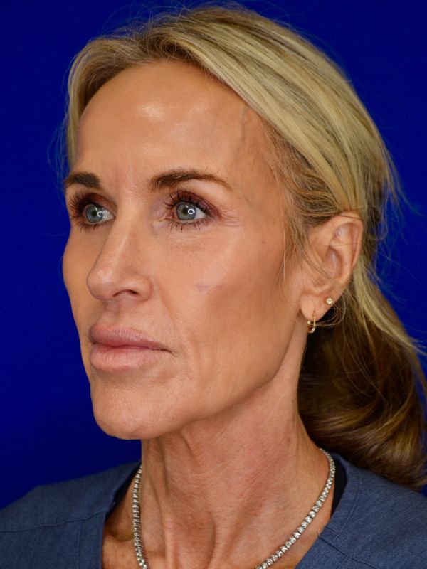 Facelift Before & After Image