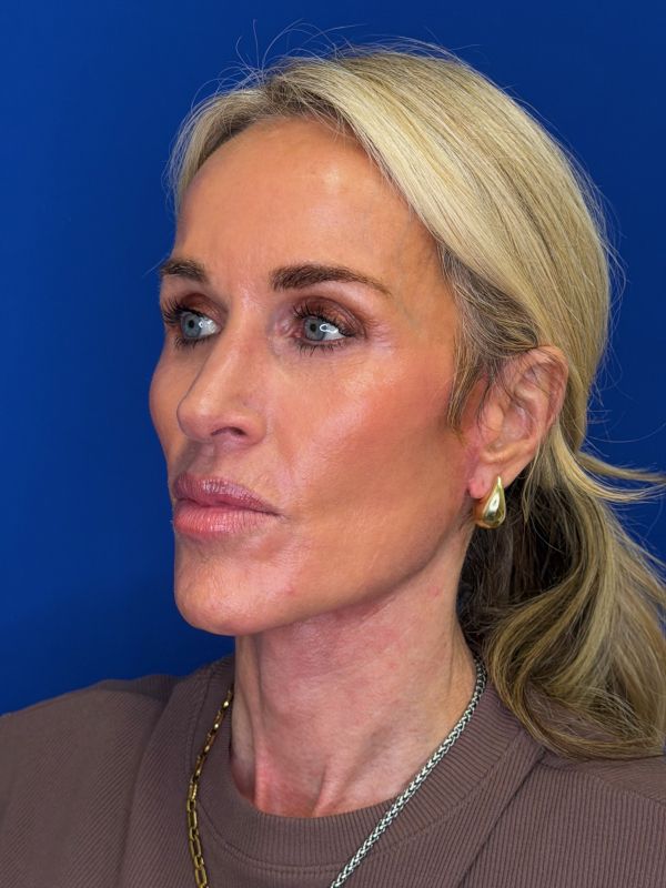 Facelift Before & After Image