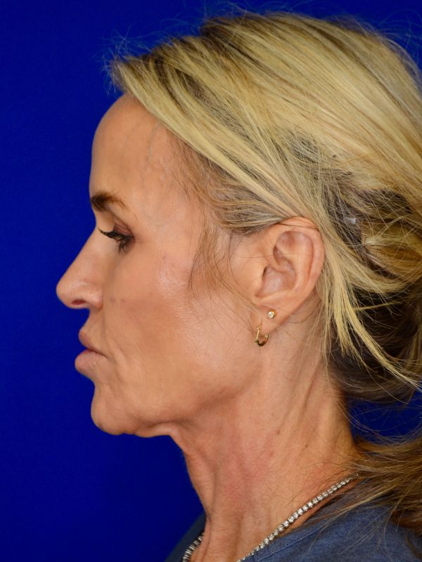 Facelift Before & After Image
