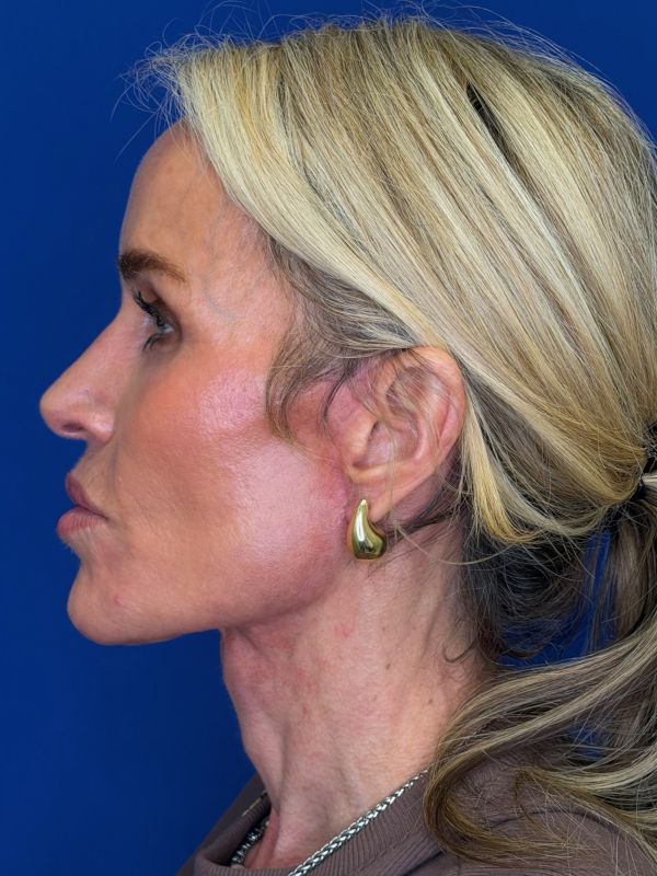 Facelift Before & After Image