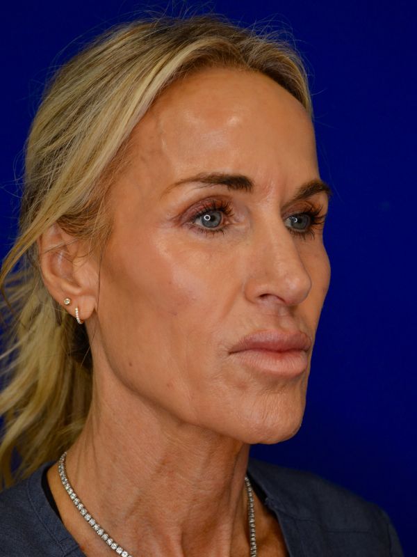 Facelift Before & After Image