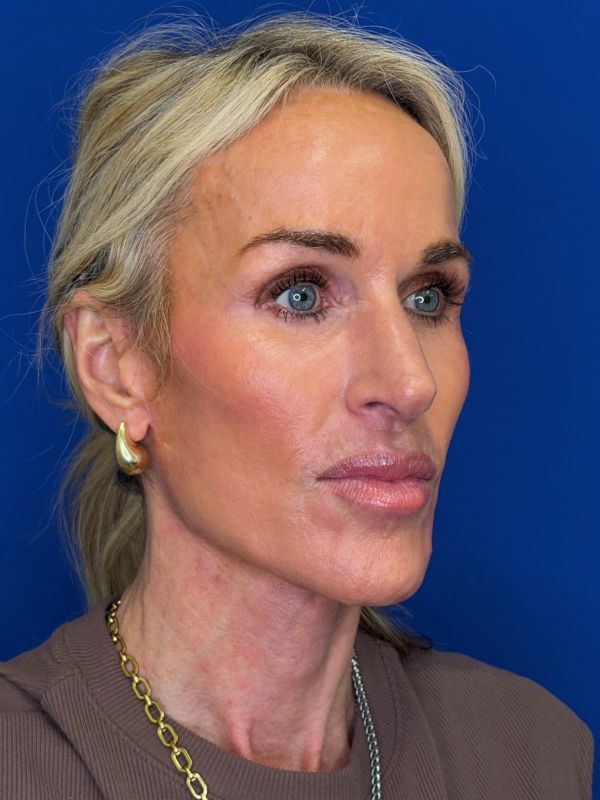 Facelift Before & After Image