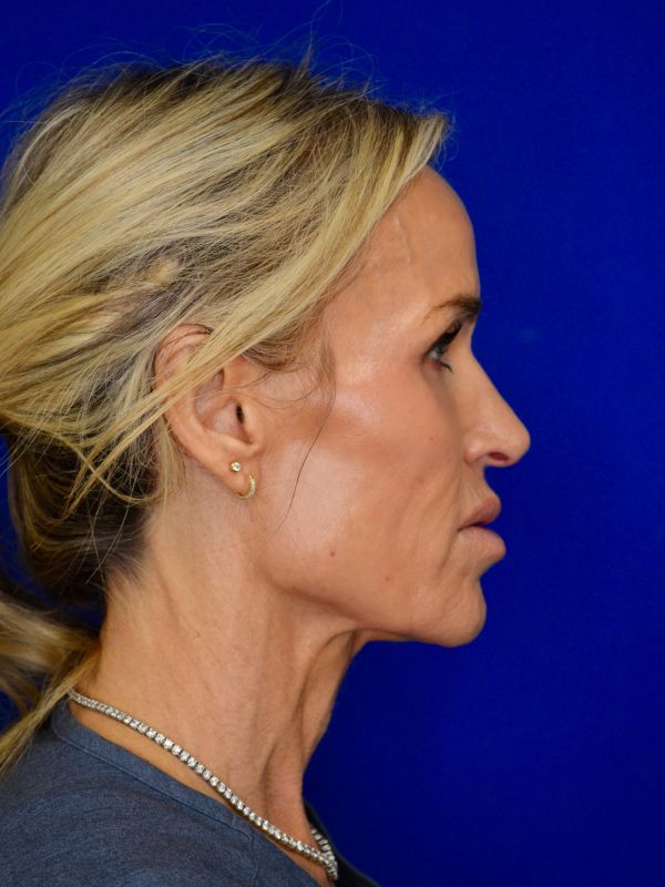Facelift Before & After Image