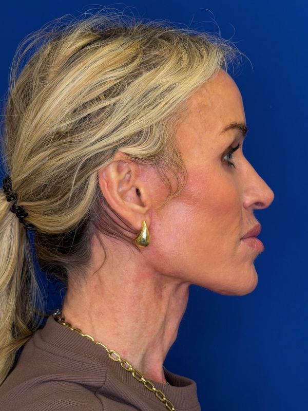 Facelift Before & After Image