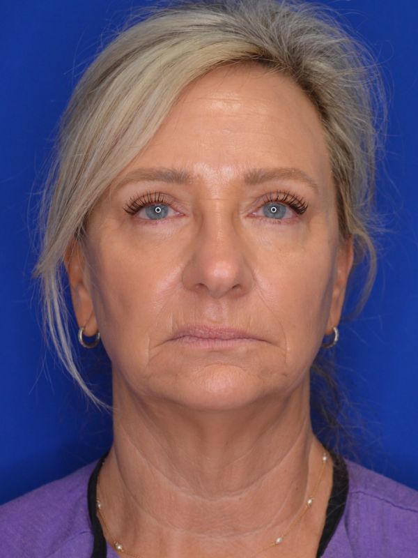 Facelift Before & After Image