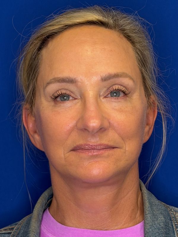Facelift Before & After Image