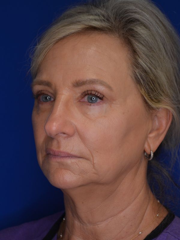 Facelift Before & After Image