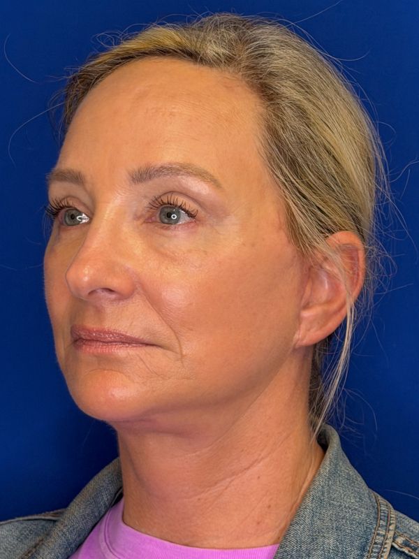 Facelift Before & After Image