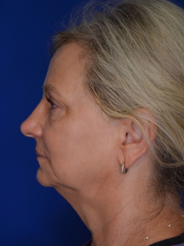 Facelift Before & After Image