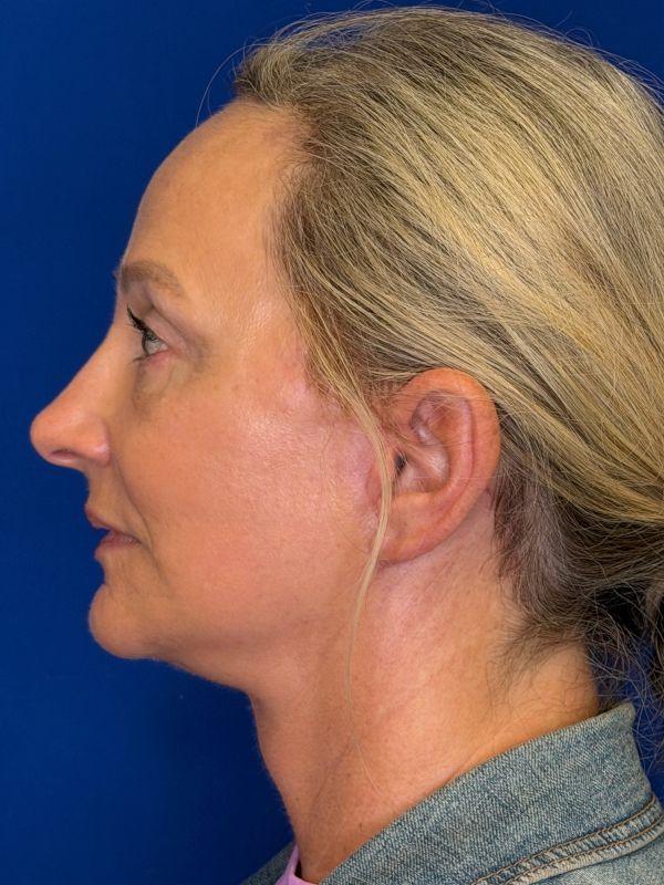 Facelift Before & After Image