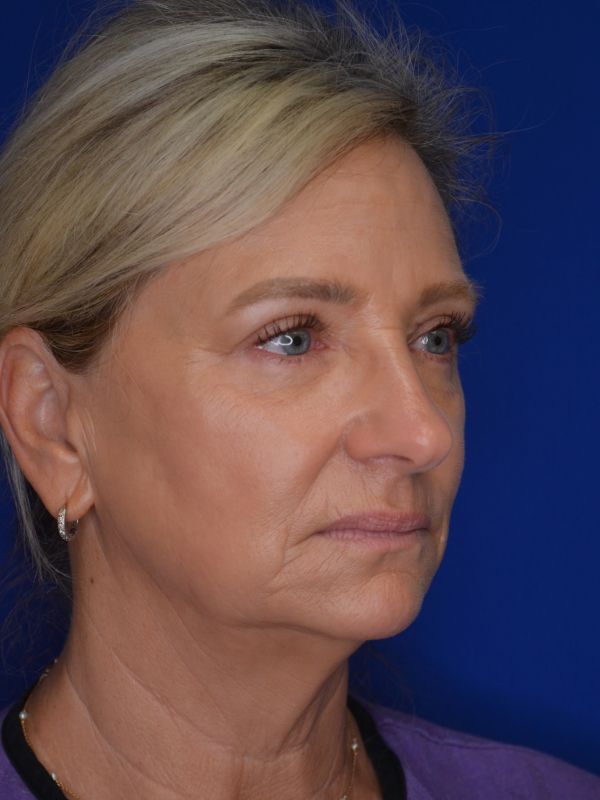 Facelift Before & After Image