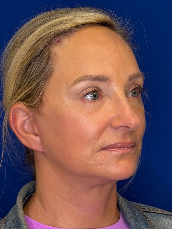Facelift Before & After Image
