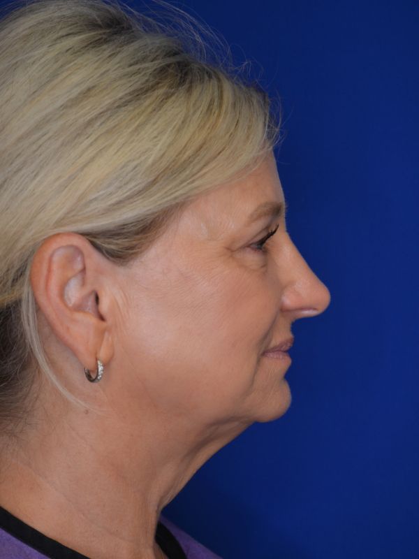 Facelift Before & After Image