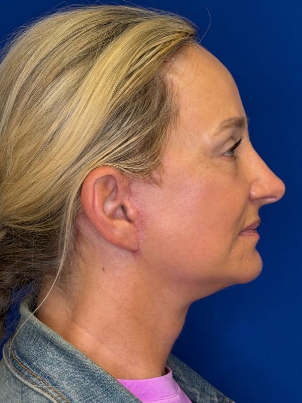Facelift Before & After Image