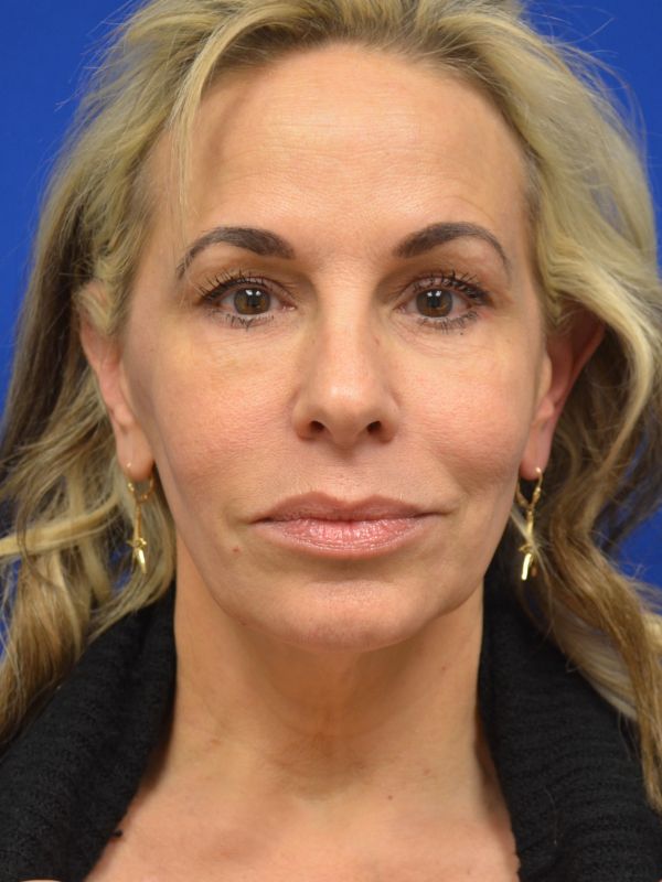 Facelift Before & After Image
