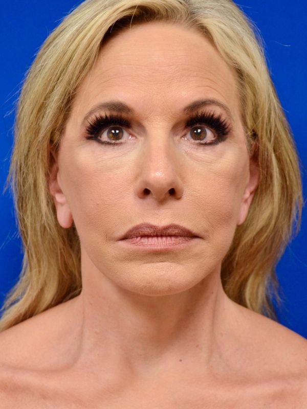 Facelift Before & After Image