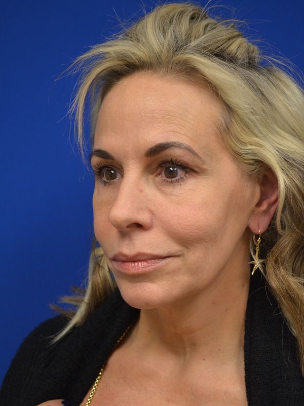 Facelift Before & After Image