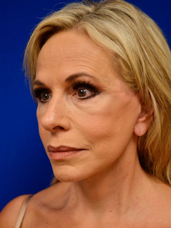 Facelift Before & After Image