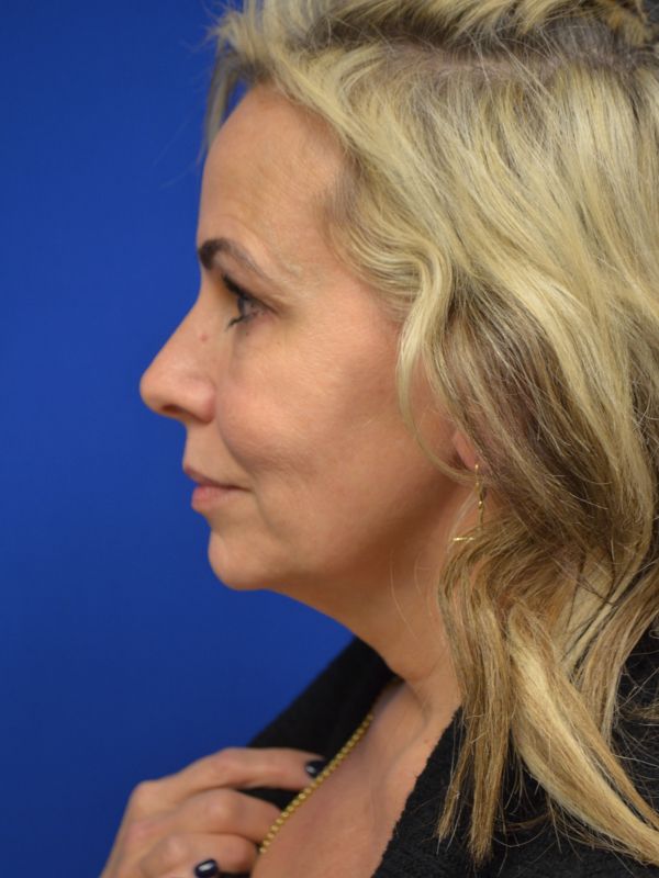 Facelift Before & After Image