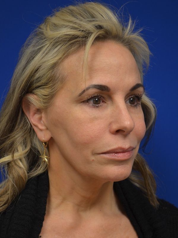 Facelift Before & After Image