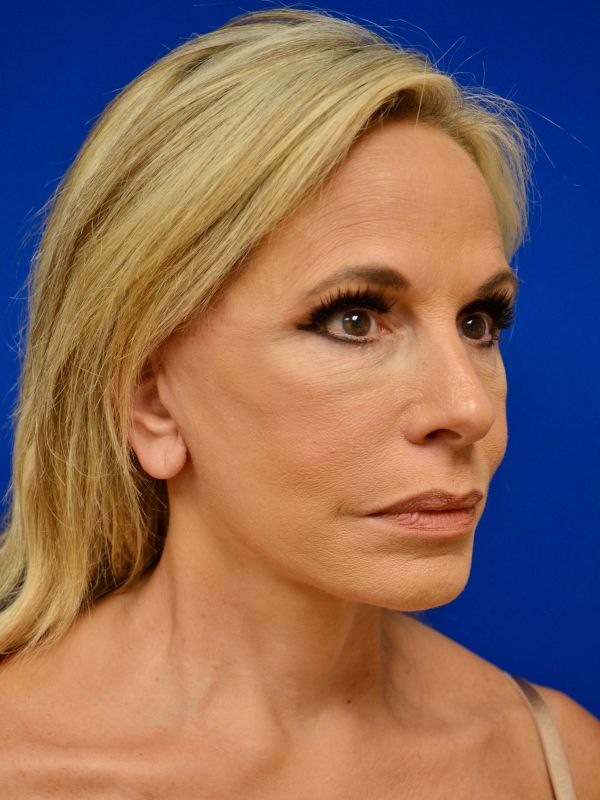 Facelift Before & After Image