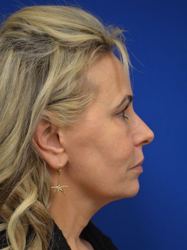 Facelift Before & After Image