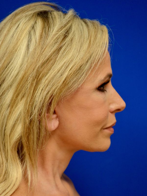 Facelift Before & After Image