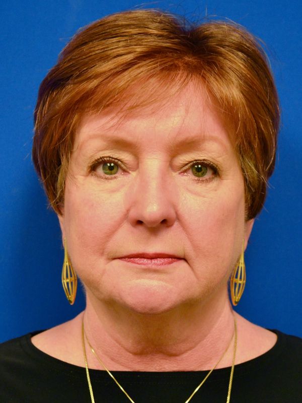 Facelift Before & After Image