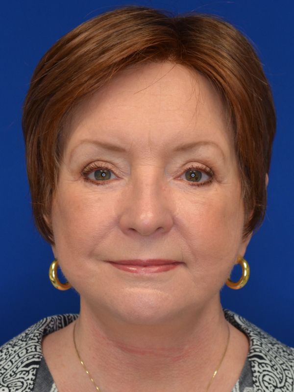 Facelift Before & After Image