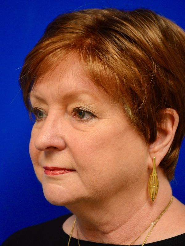 Facelift Before & After Image