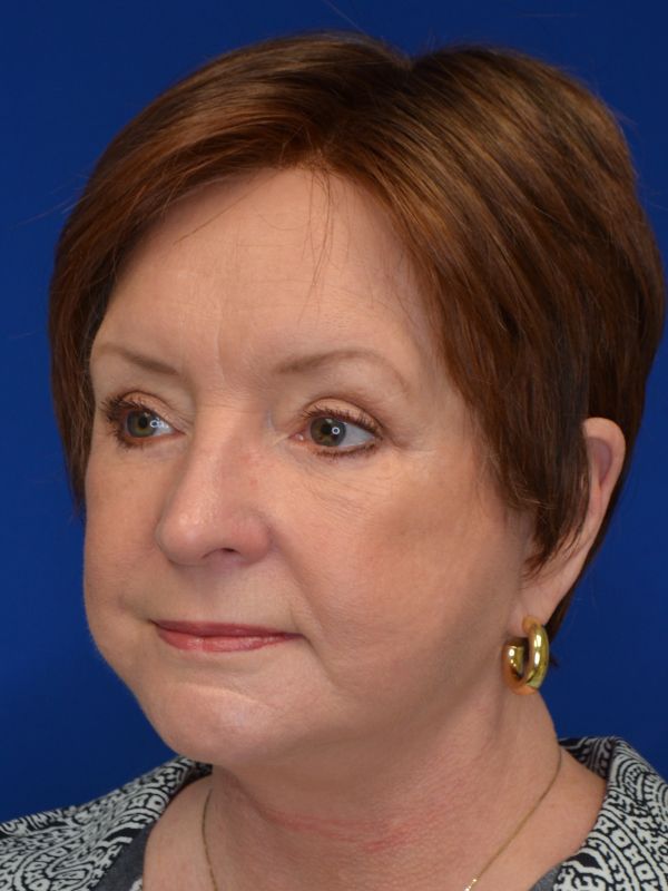 Facelift Before & After Image