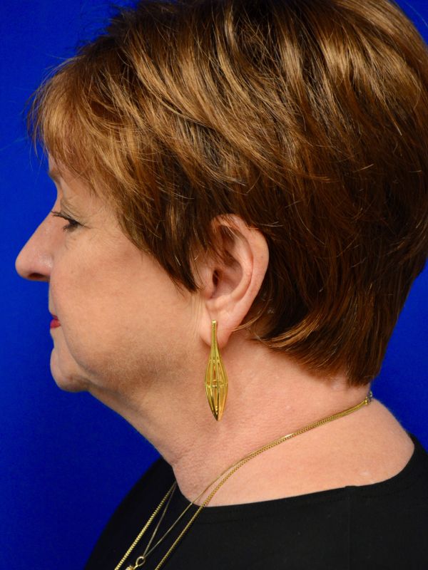 Facelift Before & After Image