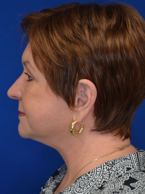 Facelift Before & After Image